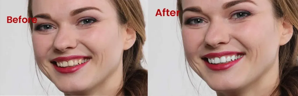 teeth-whitening-before-after